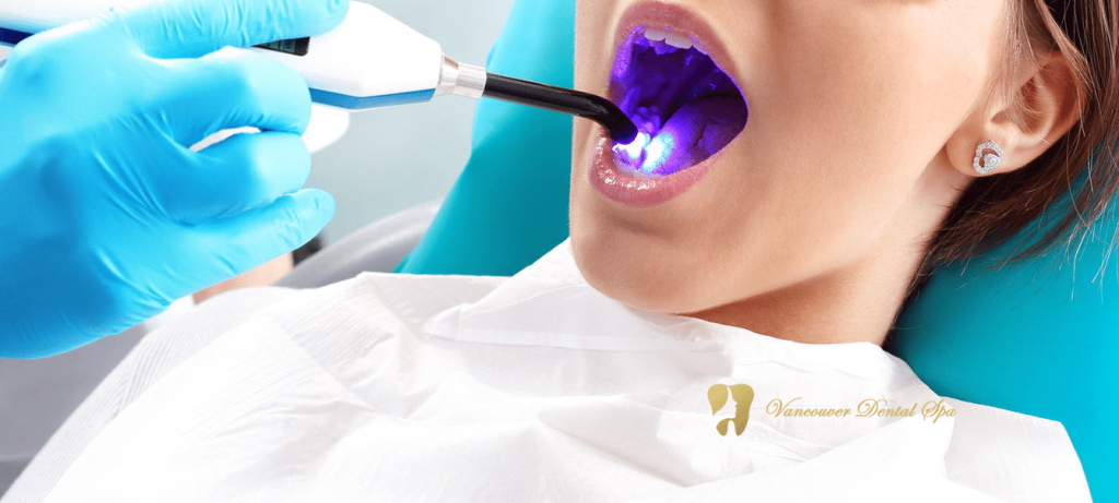 Laser Dentistry clinic in Vancouver