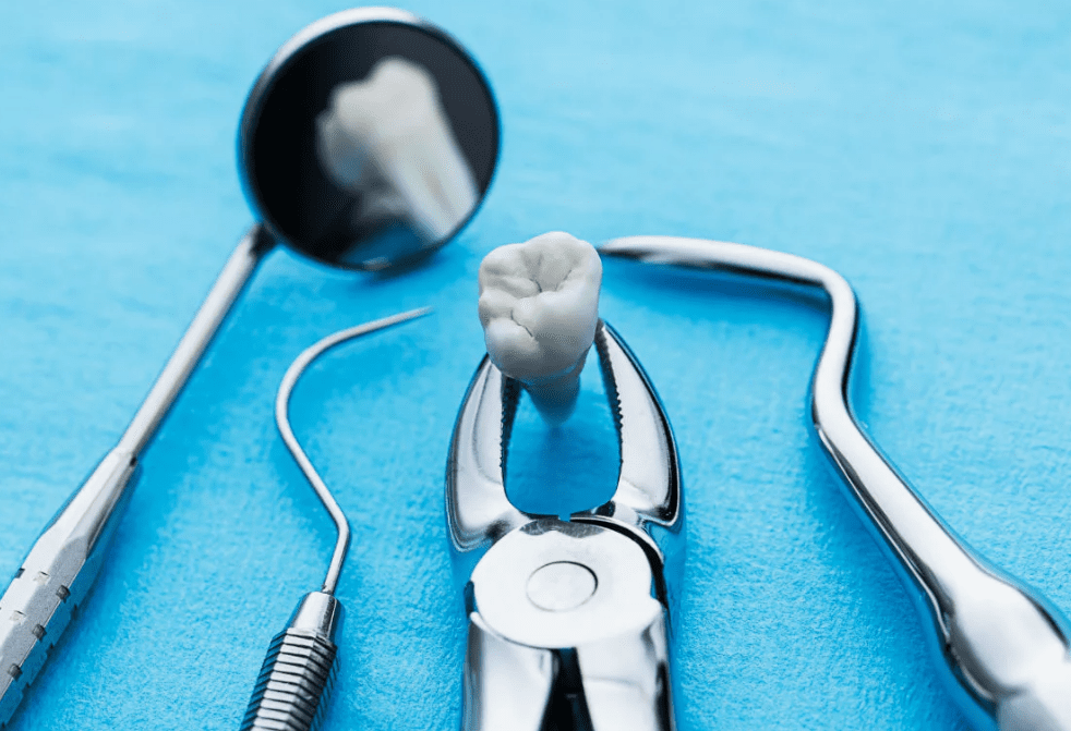 Tooth Extractions in Vancouver