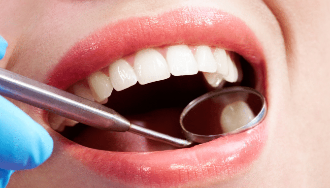 Metal Free Composite Fillings in Vancouver