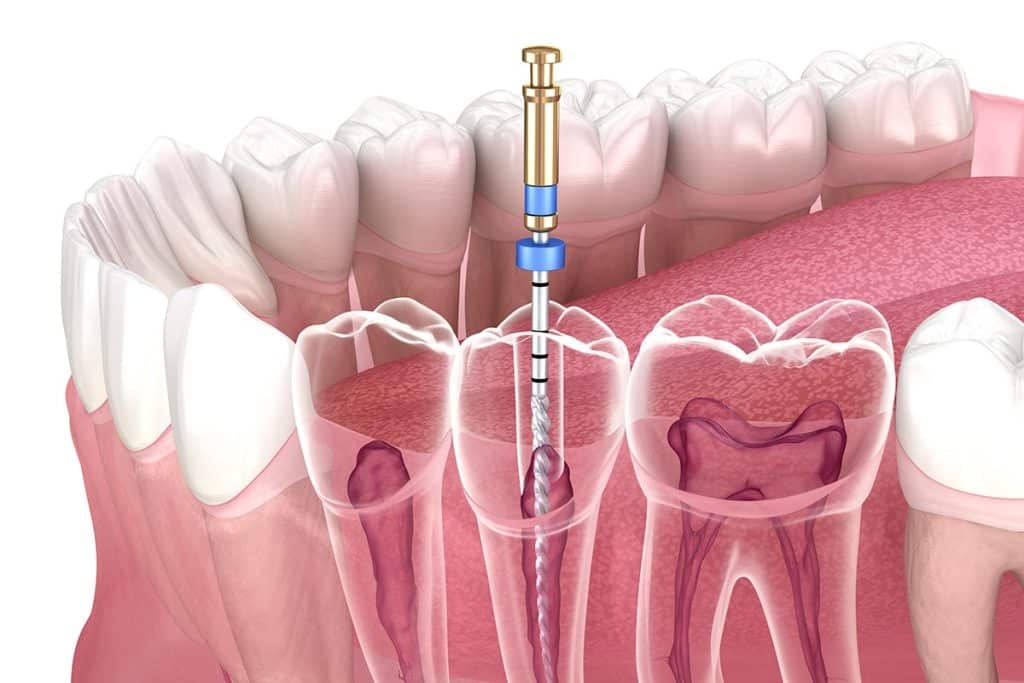 Root Canal Therapy in Vancouver